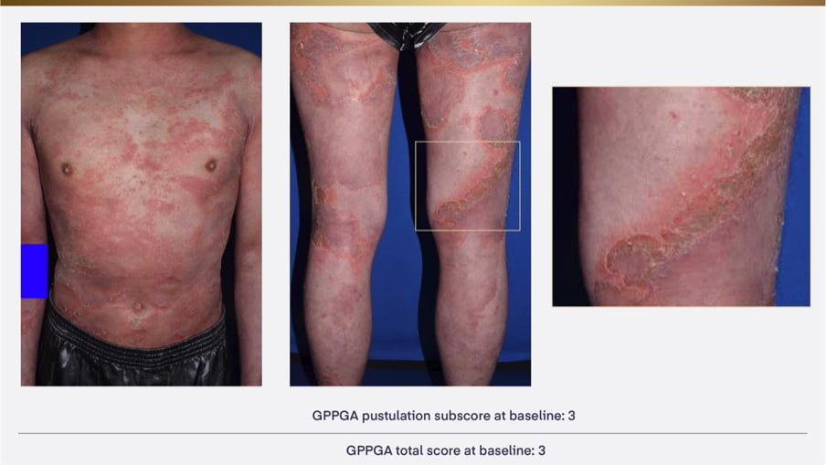 A patient with a GPP flare 