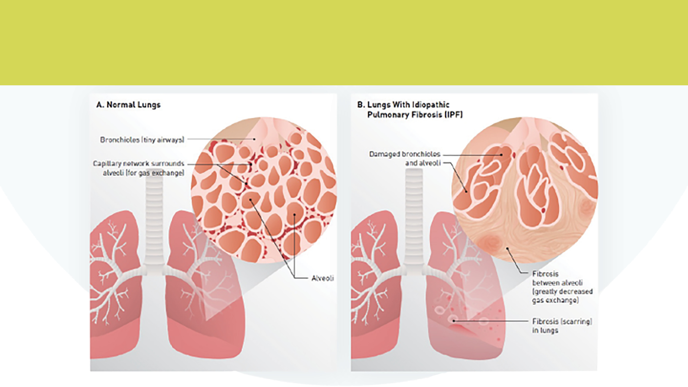 Diagnostic & Clinical course of PF-ILD/SSC-ILD