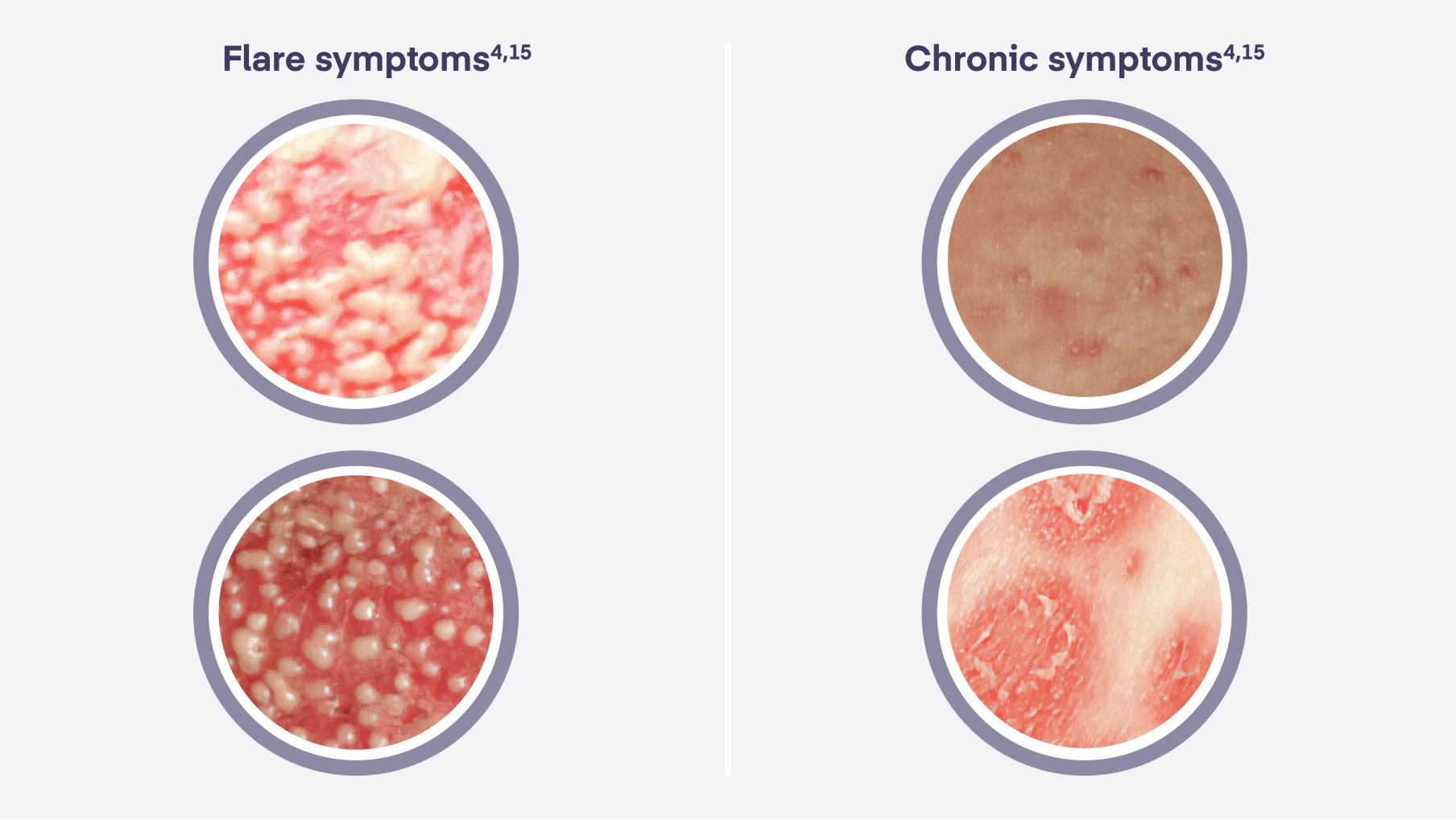 Generalized pustular psoriasis flare and Chronic symptoms